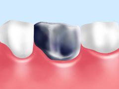 銀歯（人工歯）を白い素材にしたいなら審美治療